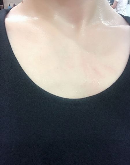 带状疱疹的症状
